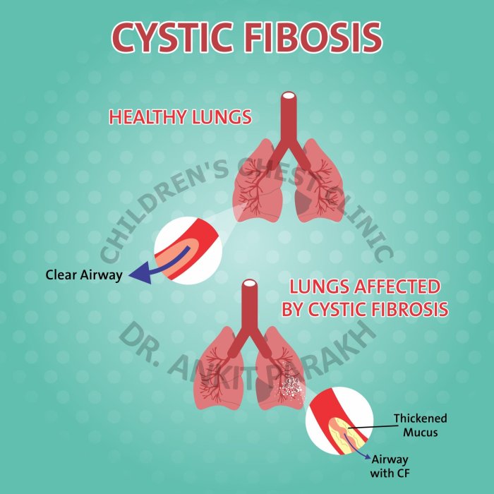 The difference between cystic fibrosis and migraine is that the