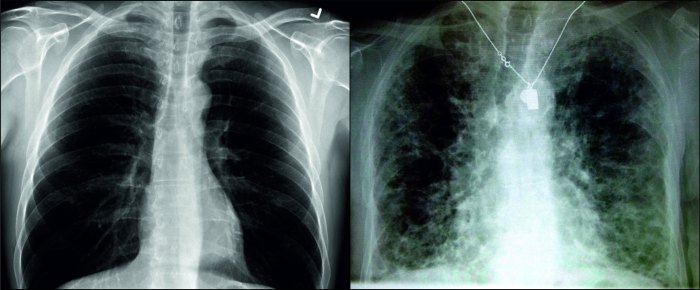 The difference between cystic fibrosis and migraine is that the