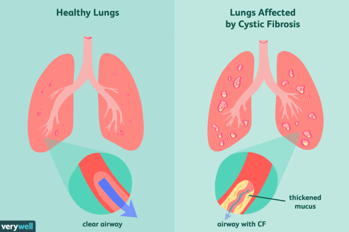 Fibrosis cystic